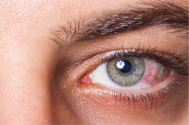 GLAUCOMA